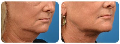 Filler (Chin Augmentation) 